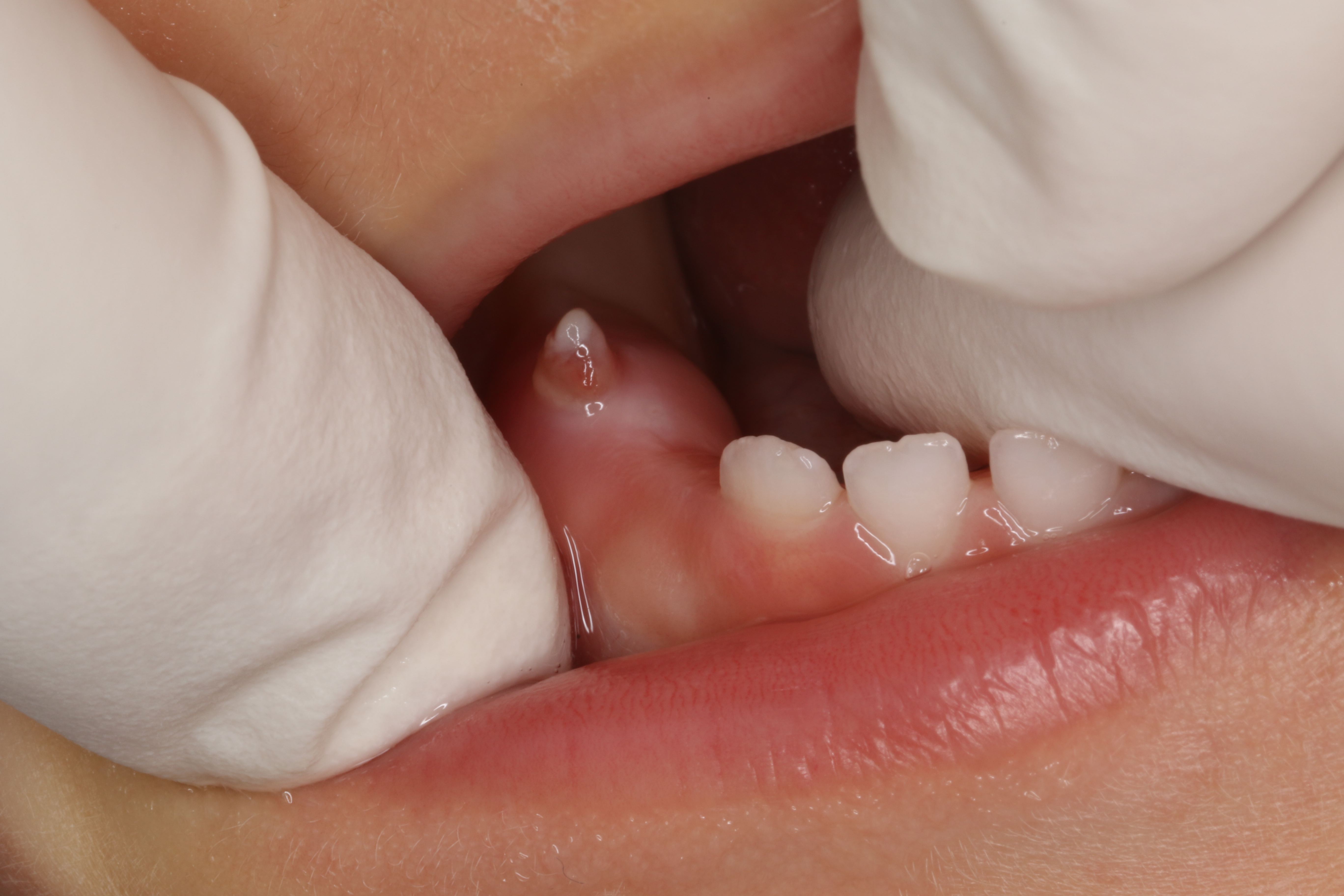 歯茎 白い 赤ちゃん 新生児の歯茎の白い点や粒の正体は？3つの可能性